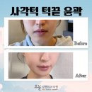 신경선 | 하치조신경선이 낮아 윤곽수술 안된다고? 신경보존윤곽수술