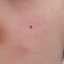 편평사마귀 제거 후기