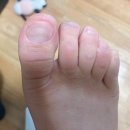 홀드핀칭전주점앤네일제작소 | [전주발톱무좀] 내성발톱&발톱무좀 전문 관리샵 홀드핀칭 네일제작소