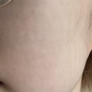 소프트나노 | 의사가 직접 받아본 나노소프트 니들 시술후기