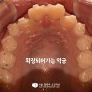 성장기 교정 시기가 결과를 바꾸는 이유 연신내역 치과 반대 교합 으로 인한 인비절라인 퍼스트 치료