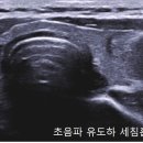 초음파 유도하 갑상선 및 두경부 세침흡입생검술 / 조직생검술 이미지