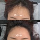 장안초교 앞 | 휑한 헤어라인 고민 끝! 닷츠에서 받은 광진구탈모관리 찐 만족 후기