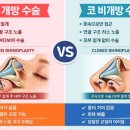 일퍼센트성형외과의원 네이버블로그