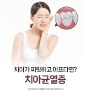 서울하얀나라치과의원 | 상남동치과 치아균열증상 어떻게 알고 치료해야할까요?