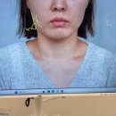 미세상피부과의원 | 신사역 치과 “레브치과” 재방문! 공장형 피부과 탈출해서 맞고 온 사각턱 보톡스 내돈내산 후기