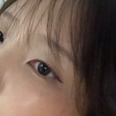 [영등포 모다스튜디오] 눈 위아래 점 복원 후기, 서울 미인점 잘 하는 곳