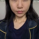 필업 | 신사동피부과 필업 볼륨콜라겐 성분 핫한 이유 후기