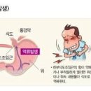 역류성식도염 원인 좋은음식 속쓰림 이미지