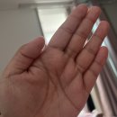 수원 다정흉부외과 손다한증 수술후기 : 1일차