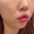 (주)피코 | 예비신부의 왕모공 여드름피부 ,여드름흉터 피코프락셀 내돈내산 후기 (전후,통증)
