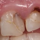 동두천치과의원 | 동두천 오래된 앞니 치아 레진 변색 착색 해결하기