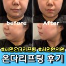 동일한의원 | 부산 서면 한의원 온다리프팅 이중턱 리프팅 2회차 통증 부작용 내돈내산 효과 후기