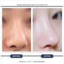 예롬성형외과의원 | 강남코성형잘하는곳 어디? 바로 [예롬]!!