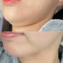 삼성유지 | 삼성역 피부과 삼성동 온다리프팅 후기 유지기간 내돈내산