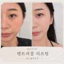 수비비안시흥배곧 | 배곧피부과 텐트리플 리프팅 후기 시흥 배곧동 피부과 다녀온 후기 (효과, 통증, 멍, 붓기)