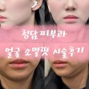 포뮬라의원 | 청담동 피부과 소멸핏 후기 심부볼·이중턱 얼굴라인 정리