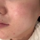 부천 중동 피부과 여드름홍조 레이저 엑셀브이 레이저 후기/관리