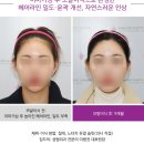 On Point Hair 온포인트헤어 | 미국 환자가 한국에서 헤어라인교정을 선택한 이유
