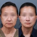 거상환경 | 안면거상리프팅? 60대는 너무 늦었다는 편견 [나이, 적정시기, 회복기간, 후기, 효과]