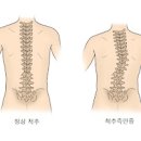 척추측만증 증상 원인 치료방법 척추 옆굽음증 이미지