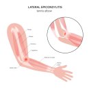 시지정형외과의원 | 시지정형외과 팔꿈치 찌릿하다면 테니스엘보를 의심해야 하는 이유