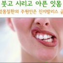 붓고 시리고 아픈 잇몸질환의 주원은 진지발리스 균 이미지