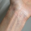 새울병원 | 임신 25주차 임신성 소양증｜입덧보다 더 힘들었던 가려움과 불안의 기록