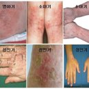 아토피성 피부염[Atopic dermatitis피부질환] 이미지