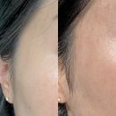 서현한의원 | 편평사마귀 성지 세군데서 시술해보고 결정한 서현역한의원