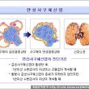 한의학 - 급성신장염 이미지