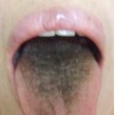 What's the Meaning of Black Coating ( Mosses ) on the Tongue? 이미지