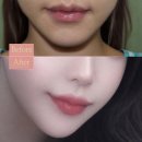 입꼬리수술 후기 8개월차 - 병원선택 팁, 후회없는 결정