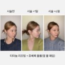 삼흥차량 | 티타늄 리프팅 + 쥬베룩 볼륨(옆 볼 패임) 효과 전&amp;후 비교 : 선릉역 피부과 후기