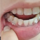 의정부연세이예쁜치과교정과치과의원 | 부분교정스타뜨(feat.의정부연세이예쁜치과)