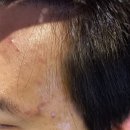 고한의원 | 강북구한의원 상계역 새살침 1회차 후기 ft.여드름 흉터