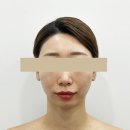 봉황3길 20 도로변 | 마산에스테틱 신포동피부관리 미레프 고주파 리프팅, 율에스테틱