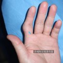 [송파 피부종양 수술] 손가락이 튀어나와서 너무 흉해요 - 손가락에 생긴 거대세포종 수술
