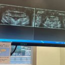 치과가 무서운 27살 쫄보 매복사랑니 발치후기🦷
