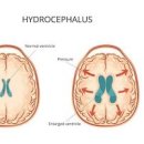 뇌수두증 원인 및 수술 (뇌수종, 물뇌증, 션트, 뇌압상승 ) 이미지