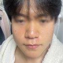 재생한의원 | 압구정 모공치료 한의원 엠톤재생약침 후기, 여드름성 피부 동생 데리고 다녀왔어요