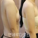 연세루다의원 | 복부 지방추출주사 후기, 팔뚝·허벅지 가격 및 추천 병원