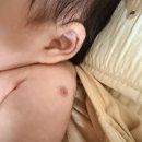 인제군보건소 | 신생아 여자 아기 보건소 Bcg접종 피내용 후기