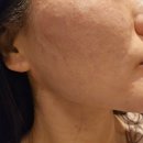 이삼일결 | 김해피부과 김해셀르디엠 받은 후기(전후사진)