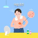 대상포진, 예방할 수 있다! /서울아산병원 피부과 정준민 교수님편 이미지