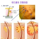 여드름에서 종창까지 - 피부의 면역기능 실종과 질환 이미지