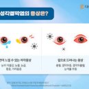 대표적인 눈 질환 종류와 증상 원인 예방법 알아봐요 이미지