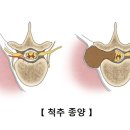 척수암 이미지