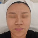 논산 피부관리 여드름흉터 슈퍼젝션 씨파우더 후기 모아르에스테틱