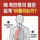 척추측만증, 왜 근육이 먼저 무너질까? 변형된 근골격계가 만드는 ‘근육 불균형’의 모든 것!! 이미지